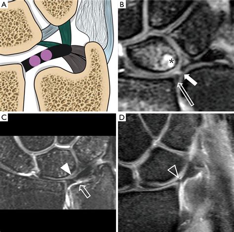 triangular fibrocartilage complex tfcc tear test|tfcc tear mri vs normal.